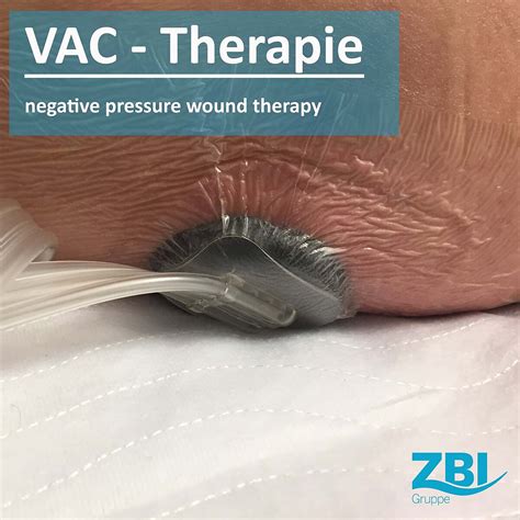 VAC blog .